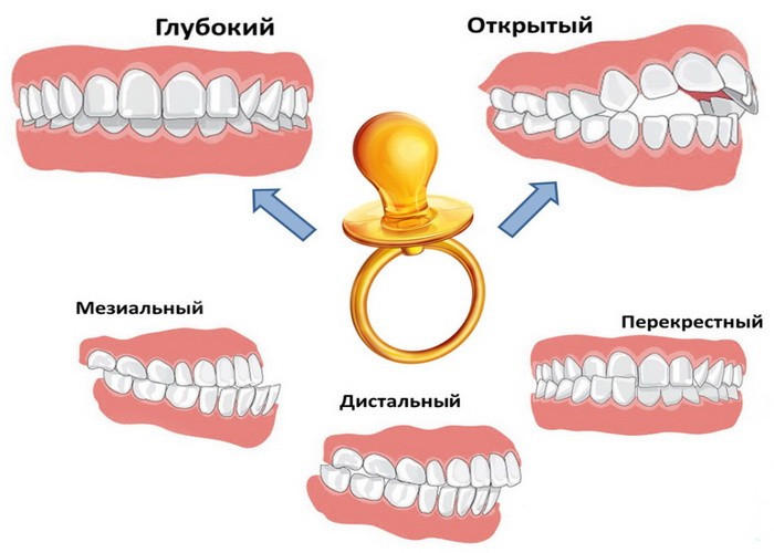 неправильный прикус у ребенка